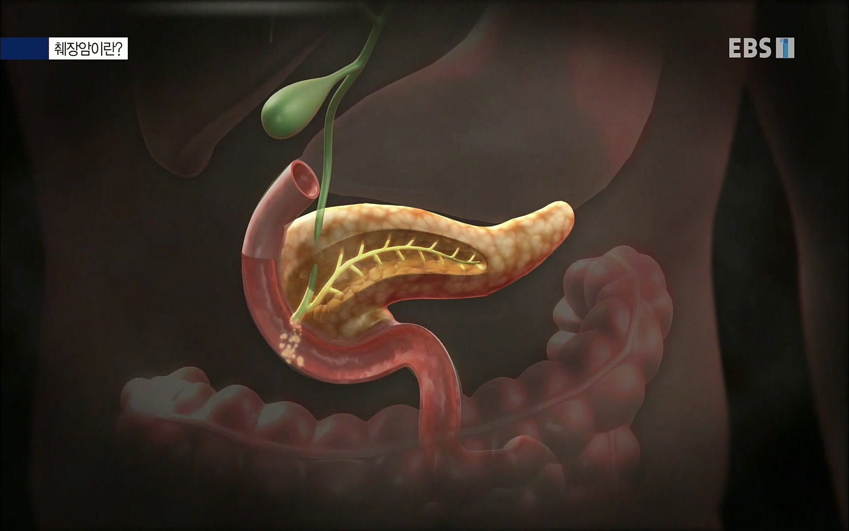 EBS 명의 헬스케어 - TV - 교육의 중심 EBS[명의 스페셜] 공포의 암, 췌장암, 담도암, 담낭암.mp4_20220902_210906.132.jpg