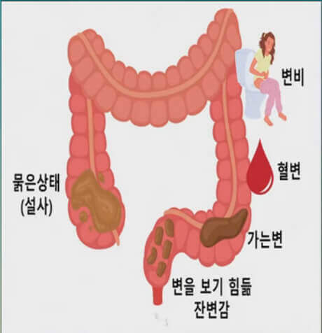  대장암, 위험군을 알고 용종, 치질 구분 조기에 대비하기