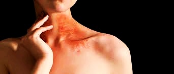  대상포진 초기증상 원인 치료방법 합병증 후유증