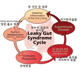 장누수증후군 증상 원인 치료법_22