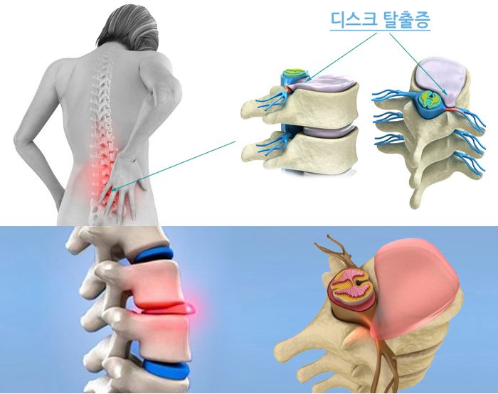 디스크탈출증