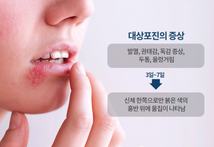 대상포진의 원인