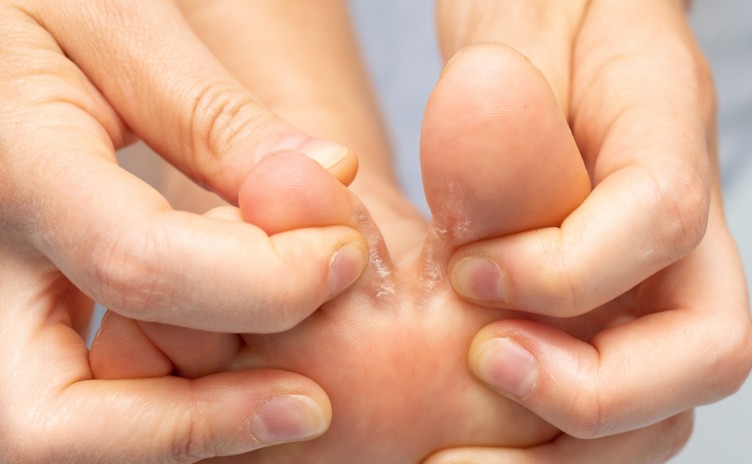 발뒤꿈치 각질&#44; 피부 백선&#44; 발 무좀 - 원인&#44; 치료방법&#44; 약복용법