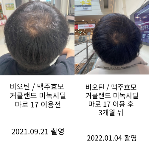 정수리 탈모 효과 전후 사진