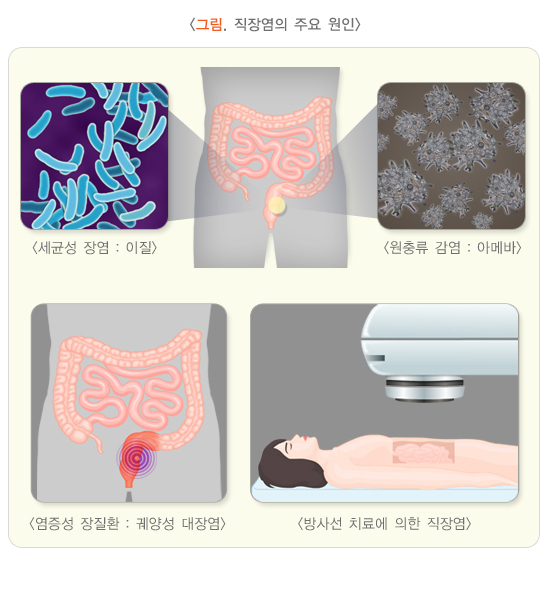  직장염