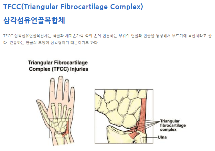 손목통증-TFCC파열
