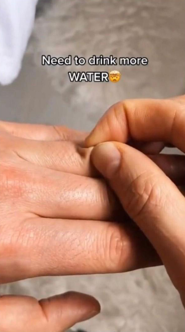  피부 팽압 테스트, 몸 수분 3초만에 확인하는 법