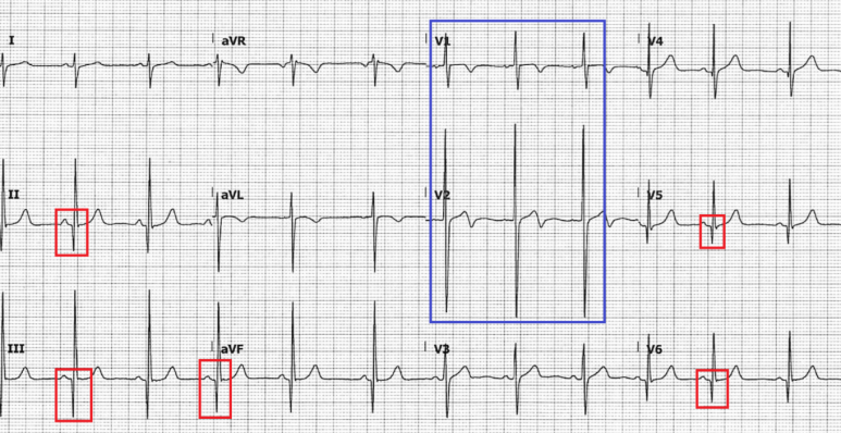 HCM (classic) ECG