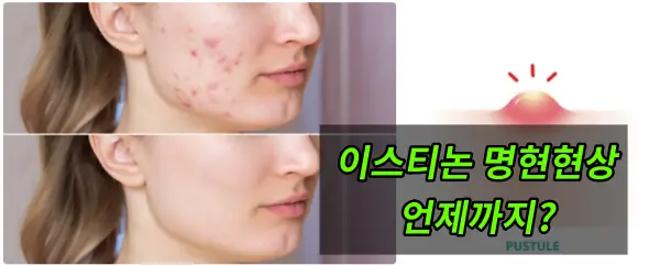 이스티논 명현현상