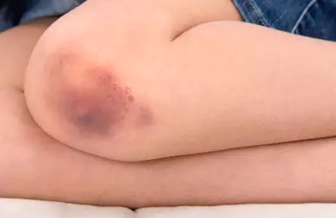  멍 빨리 빼는 법. 이렇게 따라 해보세요.