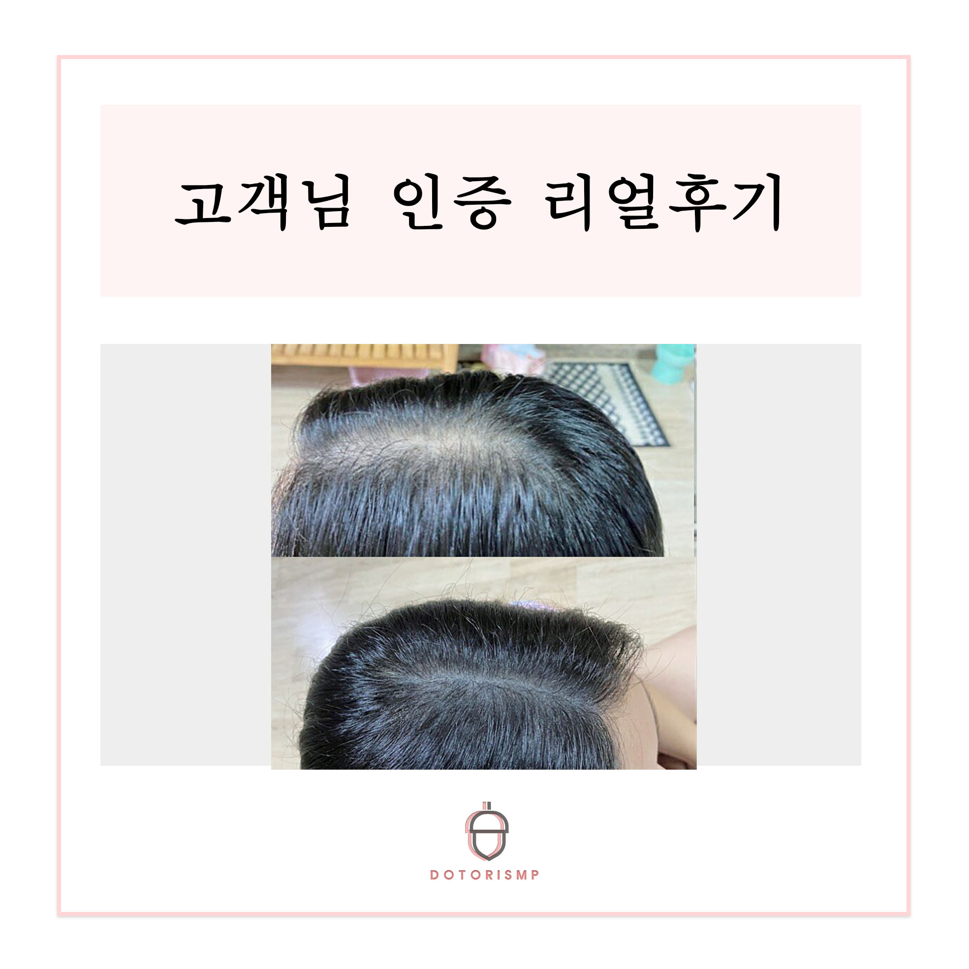  고객님인증 부산두피문신 리얼후기