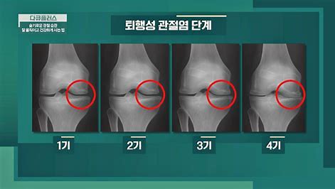  퇴행성 무릎 관절염 적정 체중만 유지해도 고통에서 벗어난다