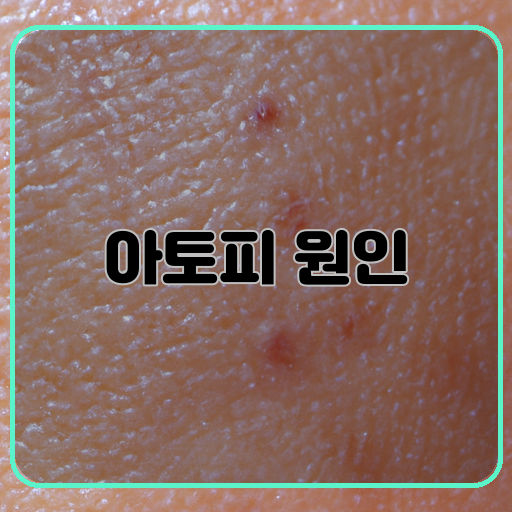 아토피-피부염-원인-자세한-설명