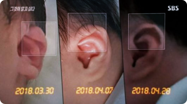  그것이 알고 싶다 ''구미 3세 여아, 생후 1개월 만에 ‘귀 모양’ 바뀌었다"
