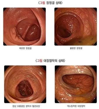 대장내시경 당일식사 주의사항 피해야 하는 음식_4