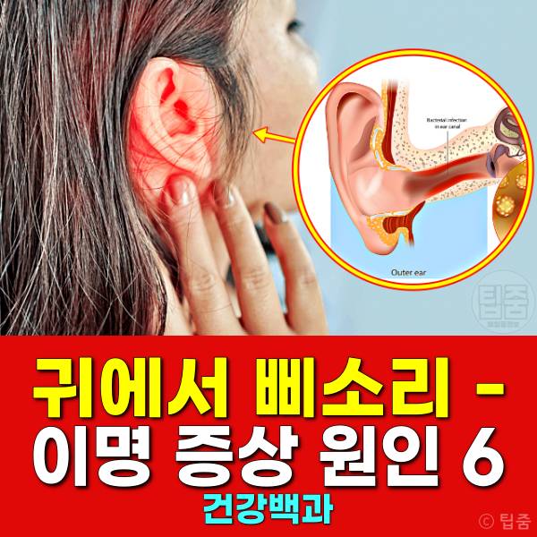 귀에서 삐소리 이명 증상 원인