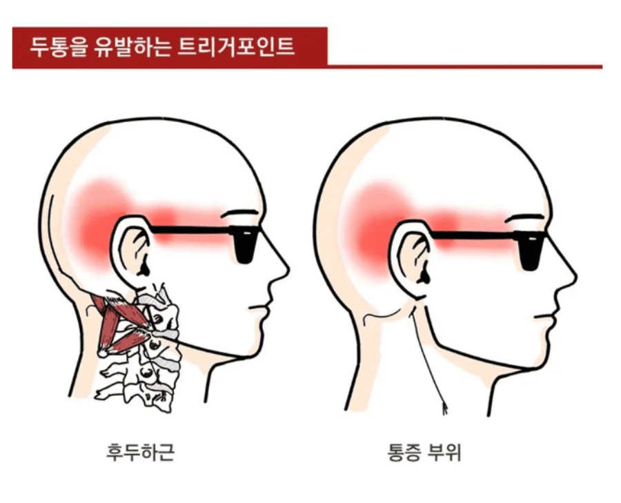 긴장성 두통잡는 후두하근 스트레칭 및 마사지방법 긴장성 두통잡는 후두하근 스트레칭 및 마사지방법