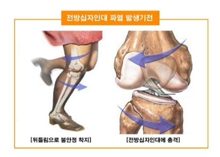 전방십자인대 파열 증상