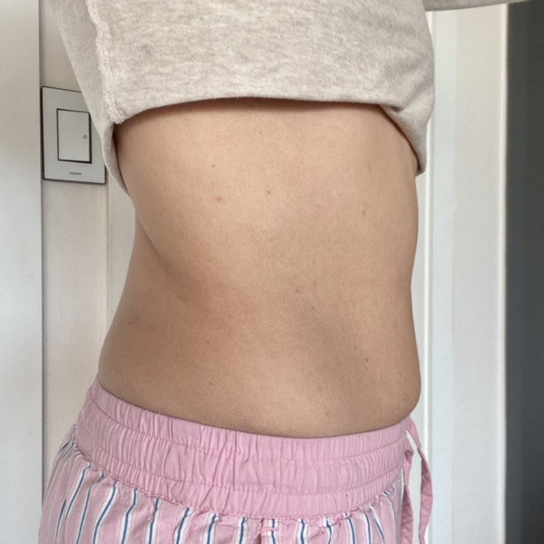 한달째 배살빼는법 실행결과 복부지방분해주사 - 7