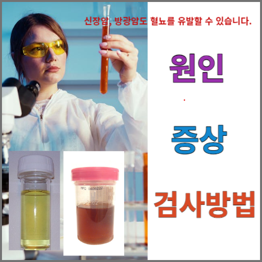 혈뇨의 원인&#44; 증상&#44; 검사 방법