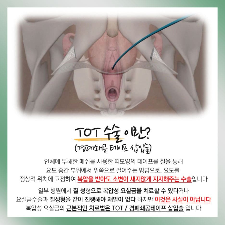 요실금증상 요실금실비 요실금 TOT수술이란?