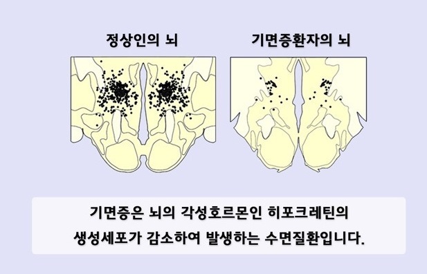 기면증 원인