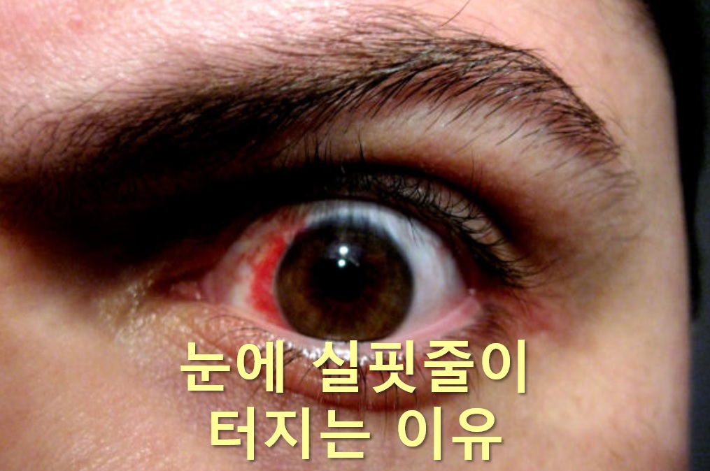  눈이 충혈되는 이유와 눈에 실핏줄이 터지는 이유