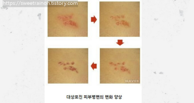 대상포진-피부변화-사진