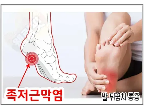족저근막염이-있으면-발바닥-뒤꿈치-통증이-발생합니다.