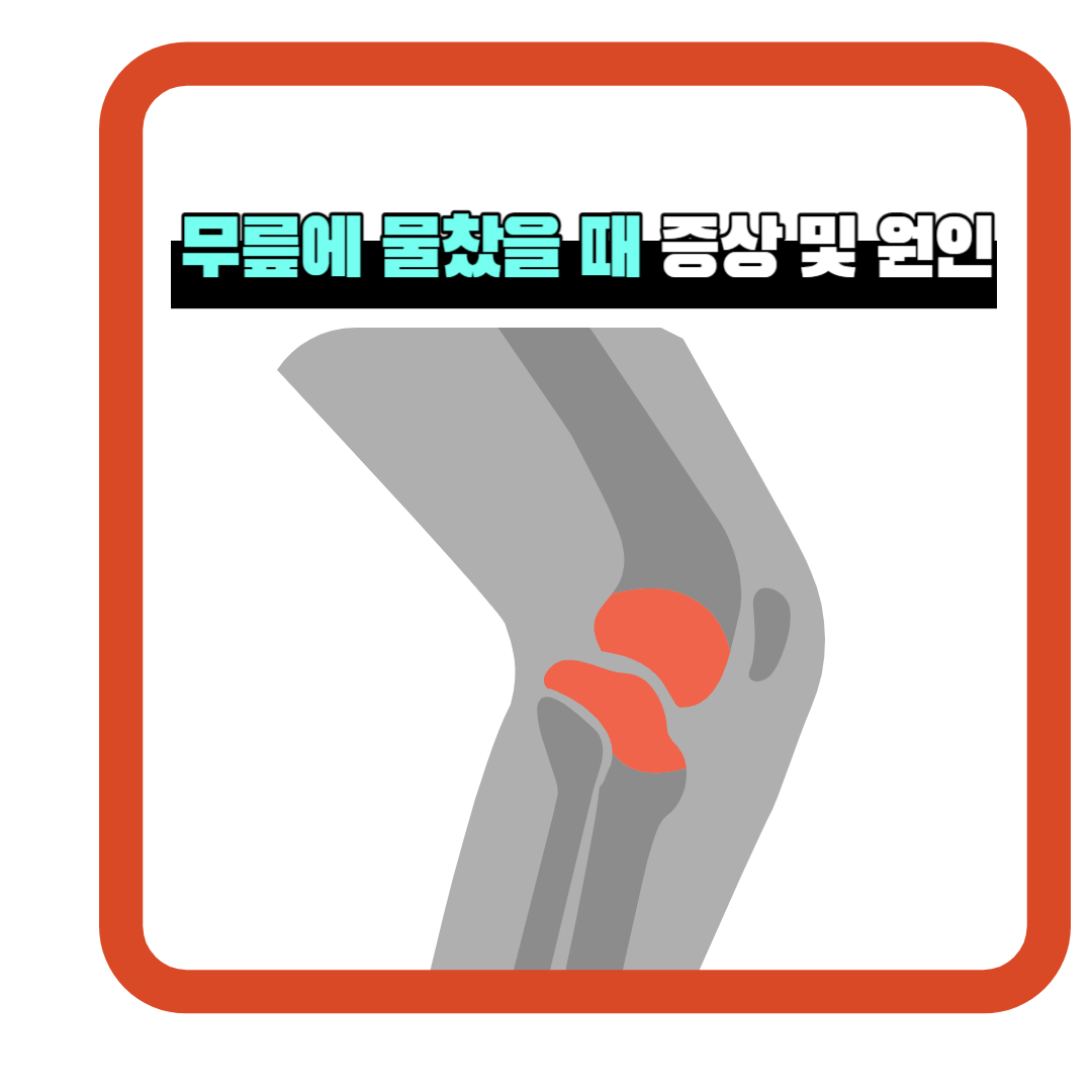  무릎에 물 찼을 때 증상, 왜 생기나요? 관절염을 이해하고 적절히 대처하기