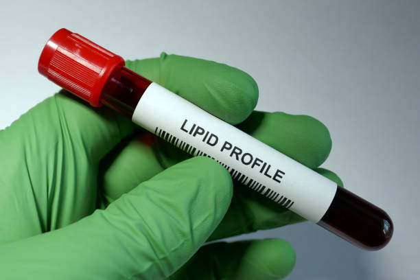 높은 중성 지방의 증상 요약 30