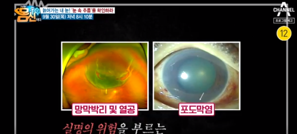  나는몸신이다 눈근육개선차즈기차효능 늙어가는내눈건강 눈속망막주름원인증상 망막박리열공포도막염예방눈건강에도움되는음식 문환식눈건강잡을아이좋아토마토워터콜라드그린쌈밥레..