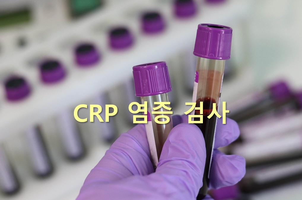  체내에 염증이 잘 생긴다면 CRP 염증 검사 받아야