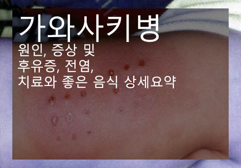  가와사키병 원인, 증상 및 후유증, 전염,  예방과 관리 상세요약