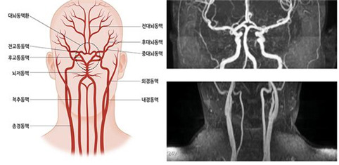 경동맥 초음파 검사란? mra 플라크 수치