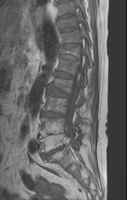 lumbar spine mri. sagittal image