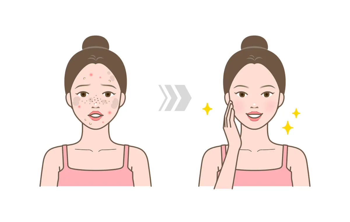 좁쌀-여드름-원인-파악