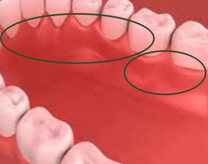 치아 밑 잇몸뼈