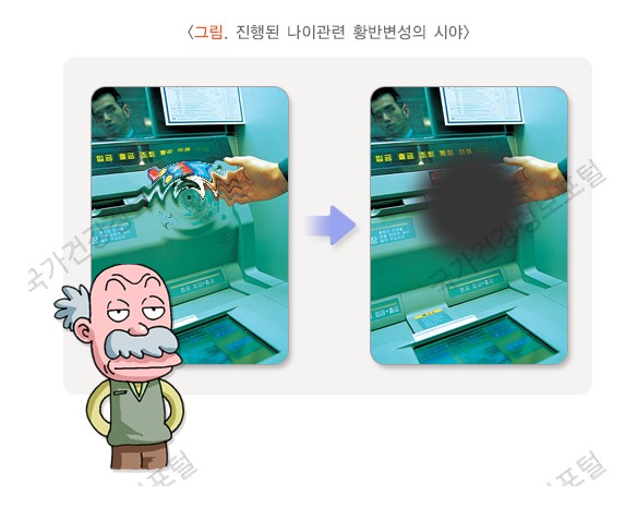 황반변성 증상_출처_국가건강포털