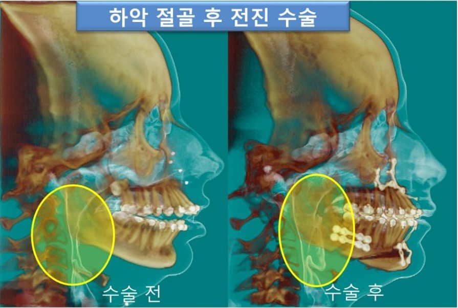 하악골 전방전위술