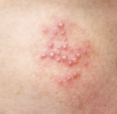 남성의 헤르페스 2형