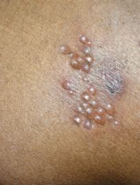 남성의 헤르페스 2형