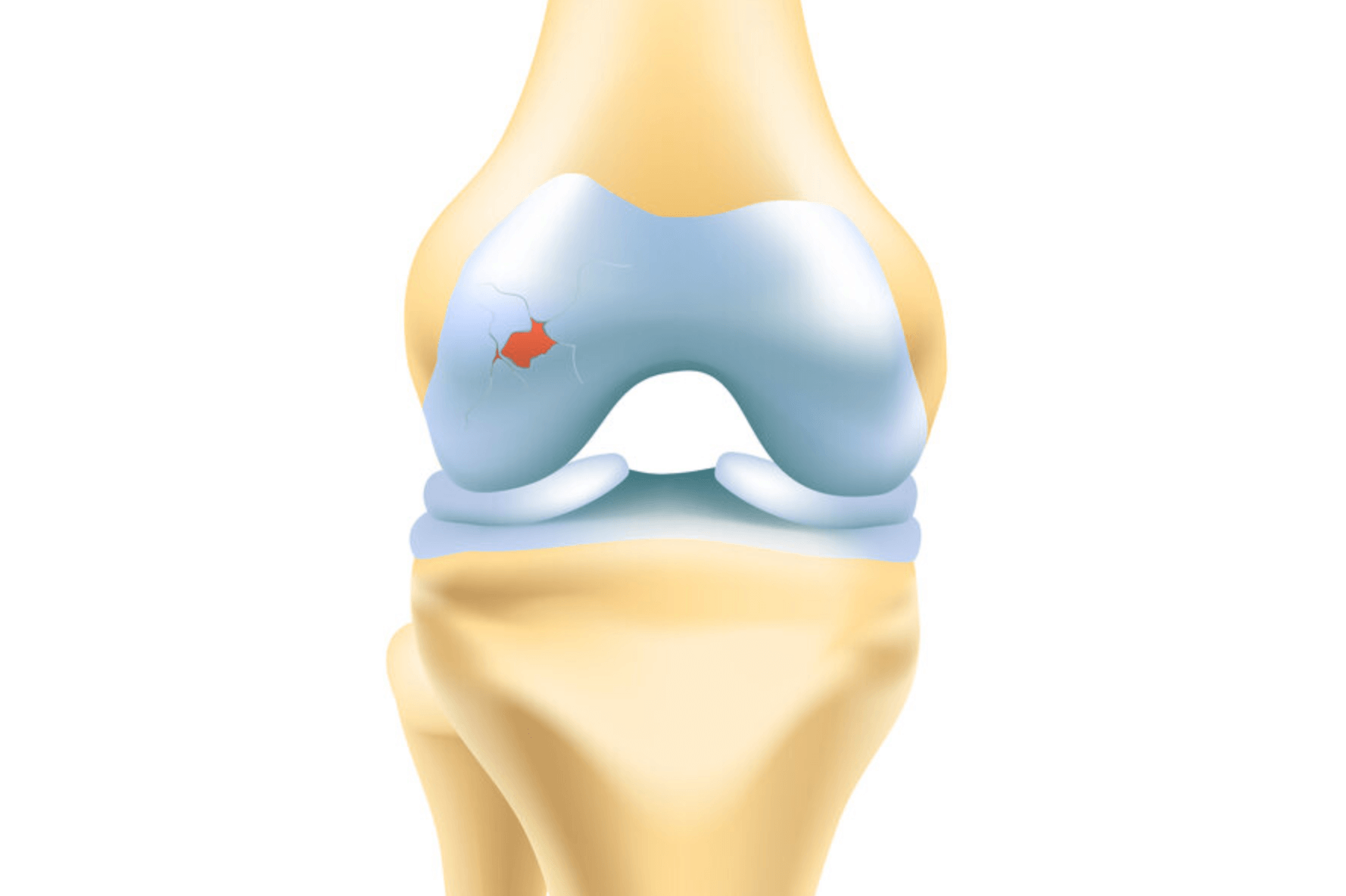 무릎 연골 찢어짐 수술