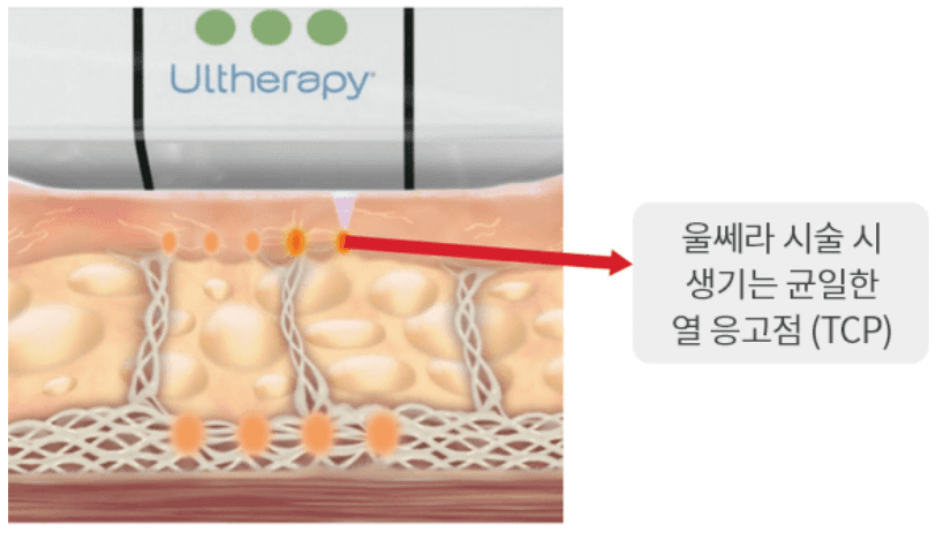 울쎄라 리프팅 가격 효과 솔직후기