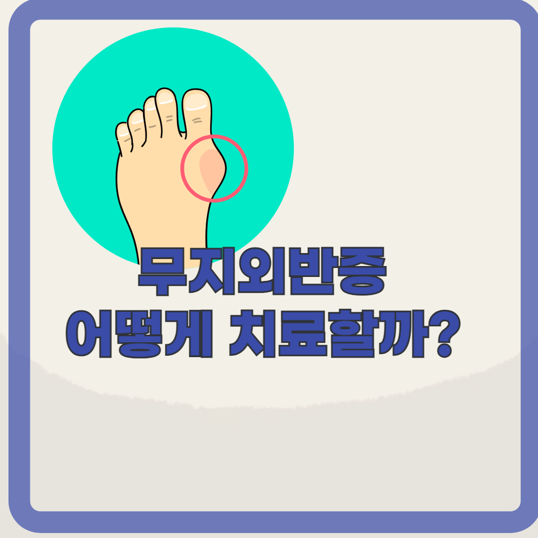 엄지발가락 통증? 무지외반증의 치료와 예방