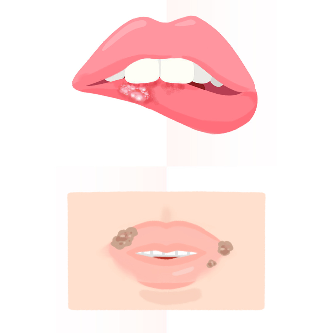 구순염 관련 그림