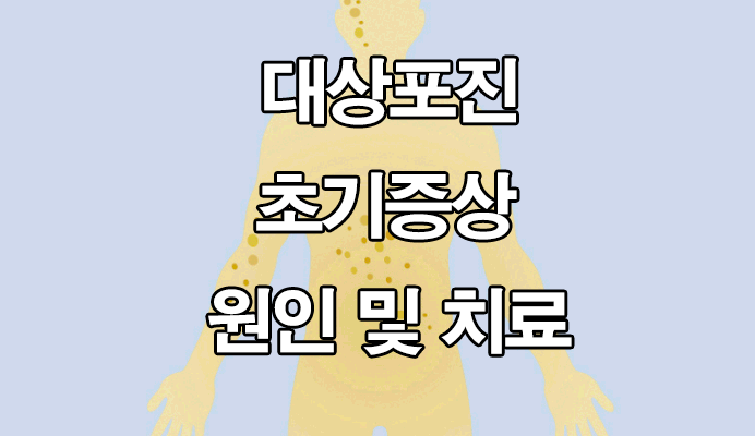  대상포진 초기증상 및 원인 : 치료, 자가진단법