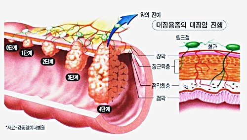 대장암 4기 증상 간전이 항암치료 기록해 놓습니다
