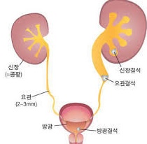  요로결석 원인 및 증상 치료 방법, 합병증 알아봤습니다.