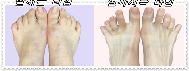  살빠지지 않는 원인은 발등이었나요?